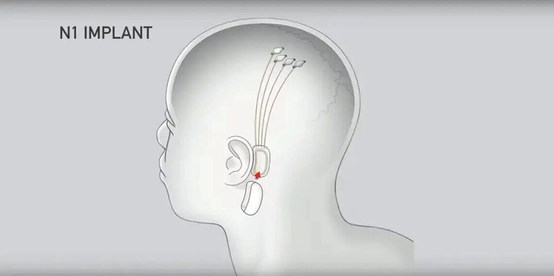 Neuralink nedir?